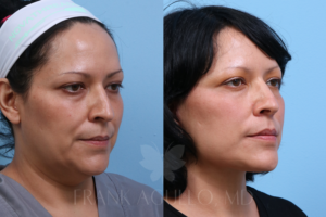 Before and after a Deep Plane Facelift by Dr. Frank Agullo in El Paso, showing a sharper jawline and restored neck contour
